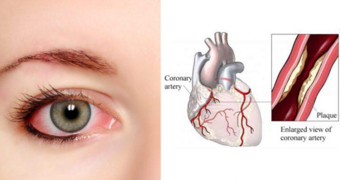 Если у вас красные глаза, причиной может быть проблема с сердцем, узнайте!