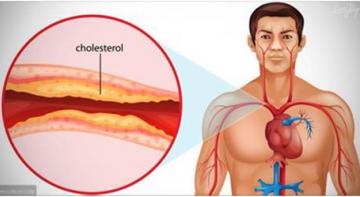 Вот, что вам нужно знать о вашем холестерине!